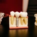 The importance of fluoride